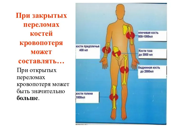 При закрытых переломах костей кровопотеря может составлять… При открытых переломах кровопотеря может быть значительно больше.