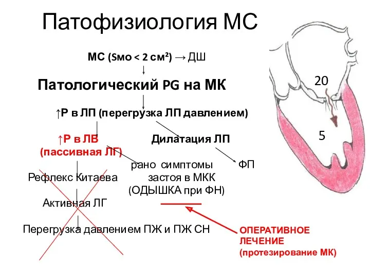 Патофизиология МС МС (Sмо Патологический PG на МК ↑Р в ЛП (перегрузка ЛП