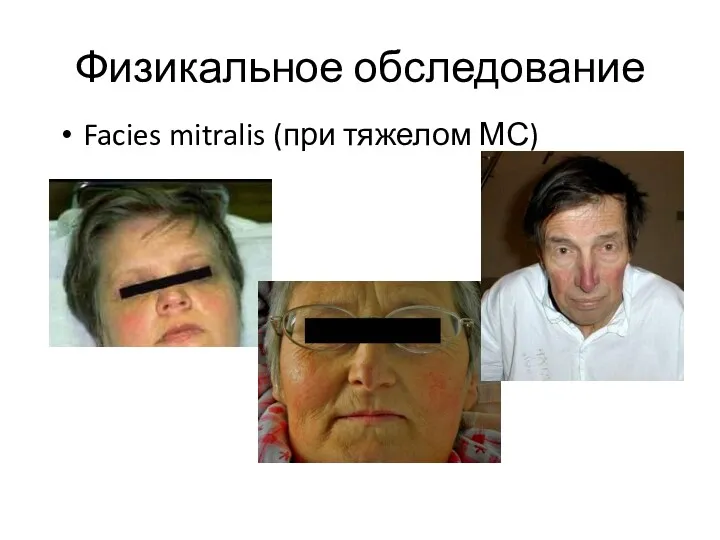 Физикальное обследование Facies mitralis (при тяжелом МС)