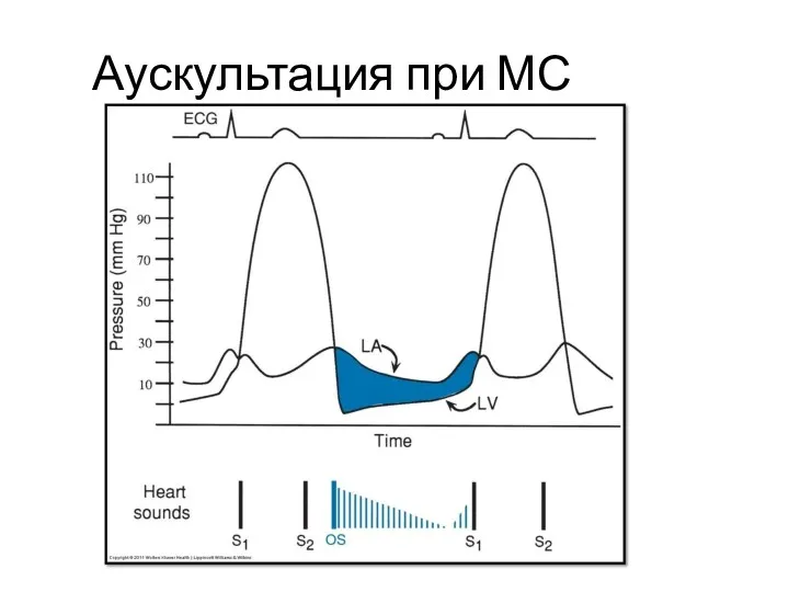 Аускультация при МС