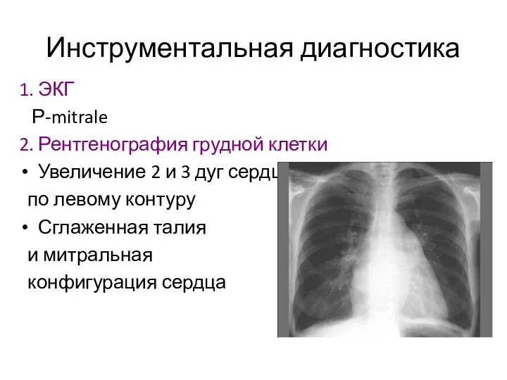 Инструментальная диагностика 1. ЭКГ Р-mitrale 2. Рентгенография грудной клетки Увеличение