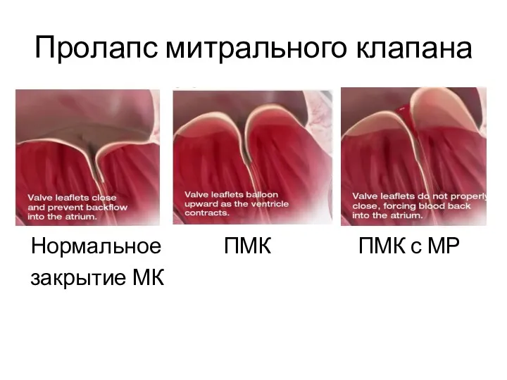Пролапс митрального клапана Нормальное ПМК ПМК с МР закрытие МК