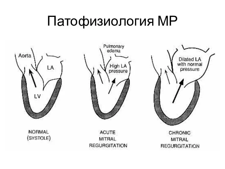 Патофизиология МР