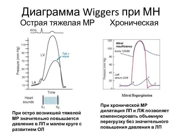 Диаграмма Wiggers при МН Острая тяжелая МР Хроническая МР При хронической МР дилатация