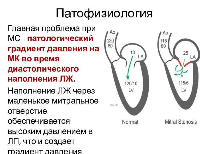 Патофизиология Главная проблема при МС - патологический градиент давления на