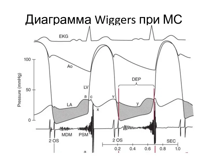 Диаграмма Wiggers при МС