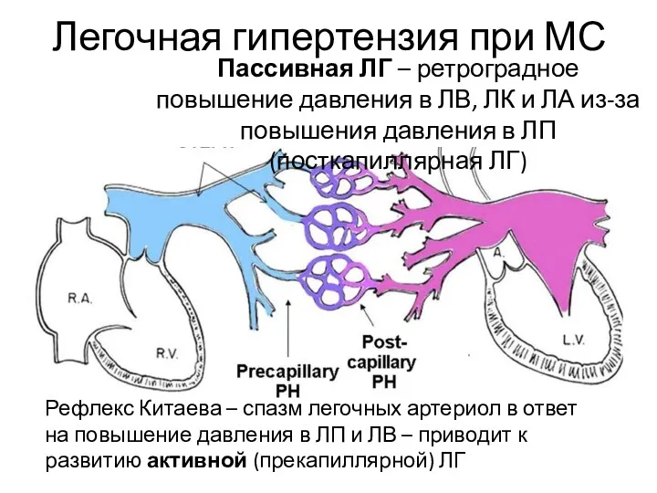 Легочная гипертензия при МС Рефлекс Китаева – спазм легочных артериол в ответ на