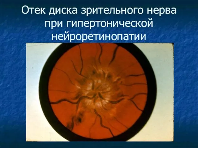 Отек диска зрительного нерва при гипертонической нейроретинопатии