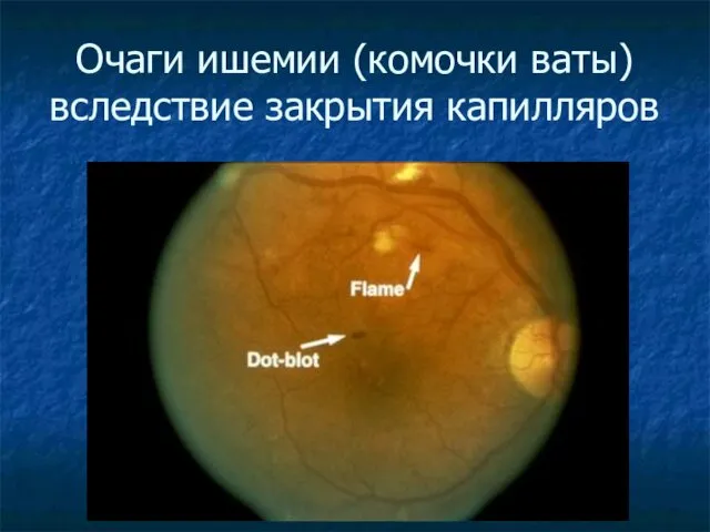 Очаги ишемии (комочки ваты)вследствие закрытия капилляров