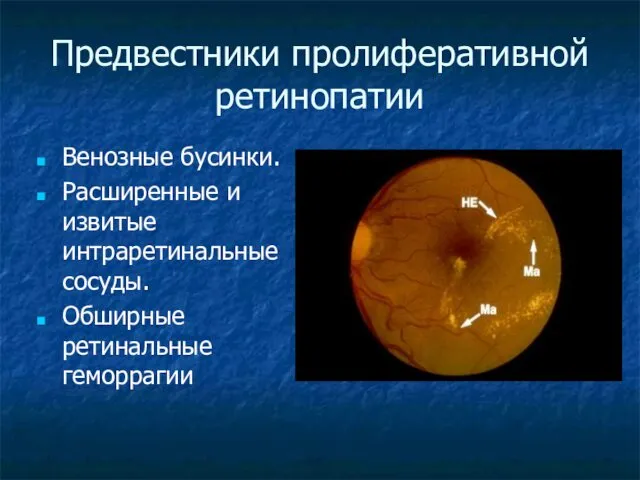 Предвестники пролиферативной ретинопатии Венозные бусинки. Расширенные и извитые интраретинальные сосуды. Обширные ретинальные геморрагии
