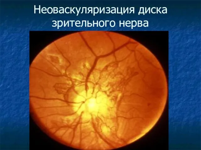 Неоваскуляризация диска зрительного нерва