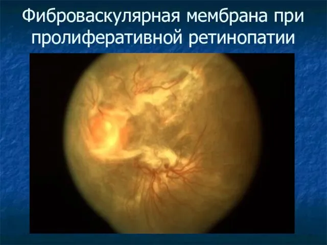 Фиброваскулярная мембрана при пролиферативной ретинопатии