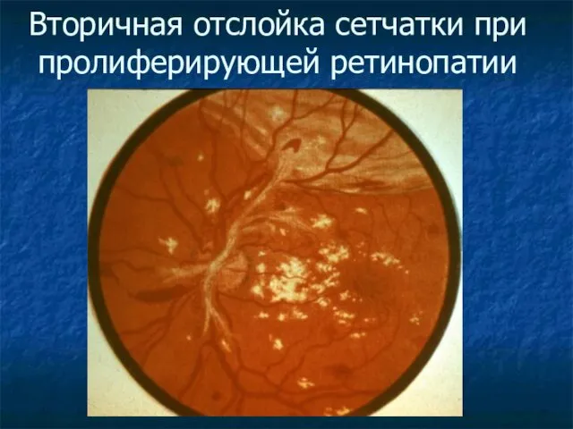 Вторичная отслойка сетчатки при пролиферирующей ретинопатии
