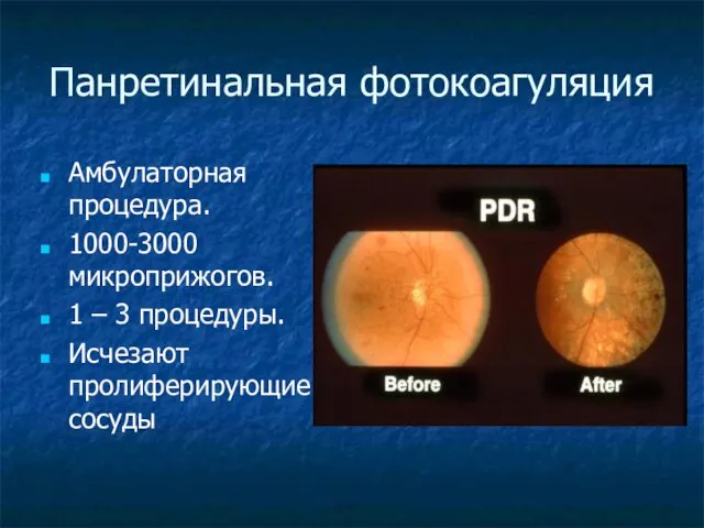 Панретинальная фотокоагуляция Амбулаторная процедура. 1000-3000 микроприжогов. 1 – 3 процедуры. Исчезают пролиферирующие сосуды