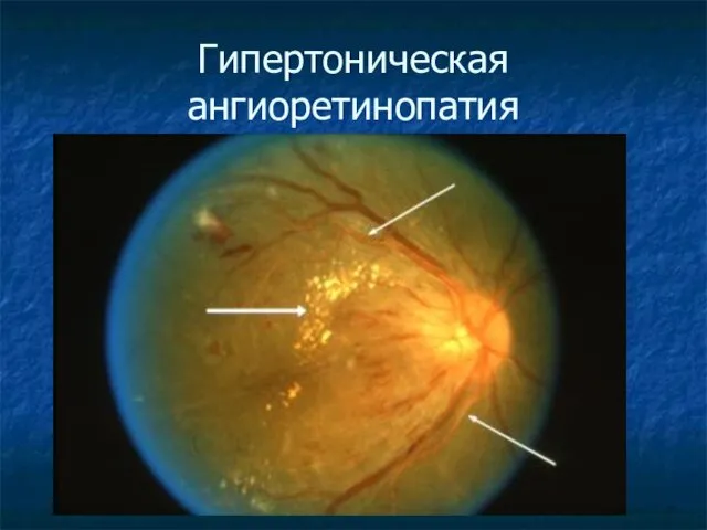 Гипертоническая ангиоретинопатия