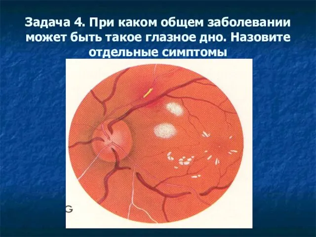 Задача 4. При каком общем заболевании может быть такое глазное дно. Назовите отдельные симптомы