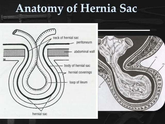 Anatomy of Hernia Sac