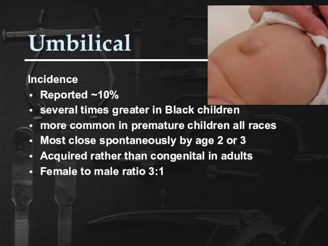 Umbilical Incidence Reported ~10% several times greater in Black children