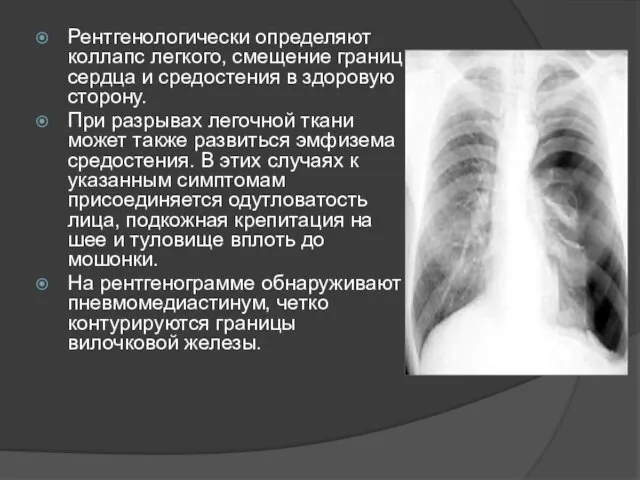 Рентгенологически определяют коллапс легкого, смещение границ сердца и средостения в здоровую сторону. При