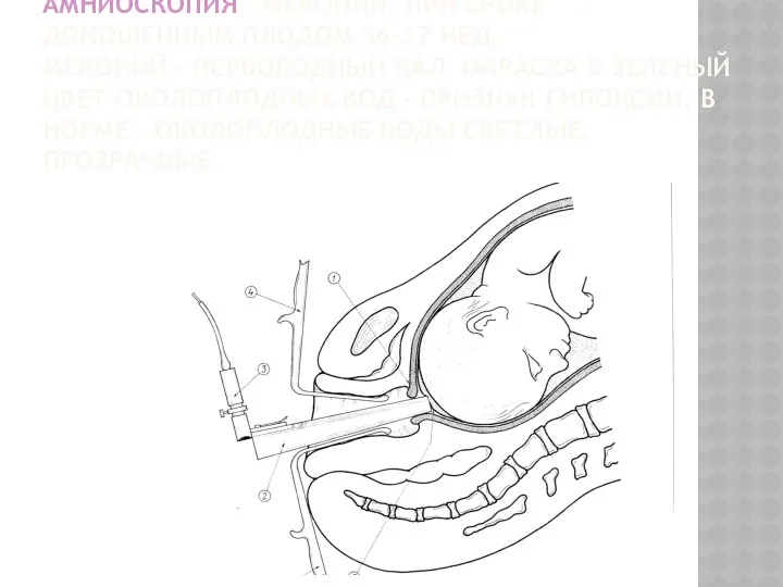 АМНИОСКОПИЯ – МЕКОНИЙ, ПРИ СРОКЕ ДОНОШЕННЫМ ПЛОДОМ 36-37 НЕД, МЕКОНИЙ