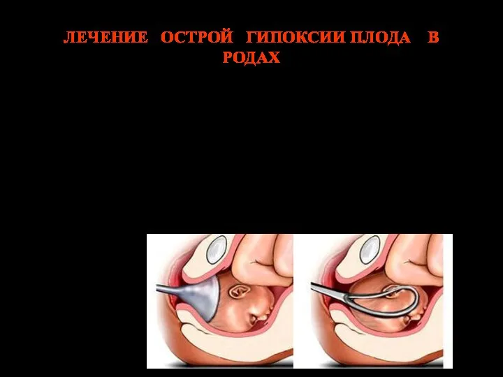 ЛЕЧЕНИЕ ОСТРОЙ ГИПОКСИИ ПЛОДА В РОДАХ Быстрое завершение родов В