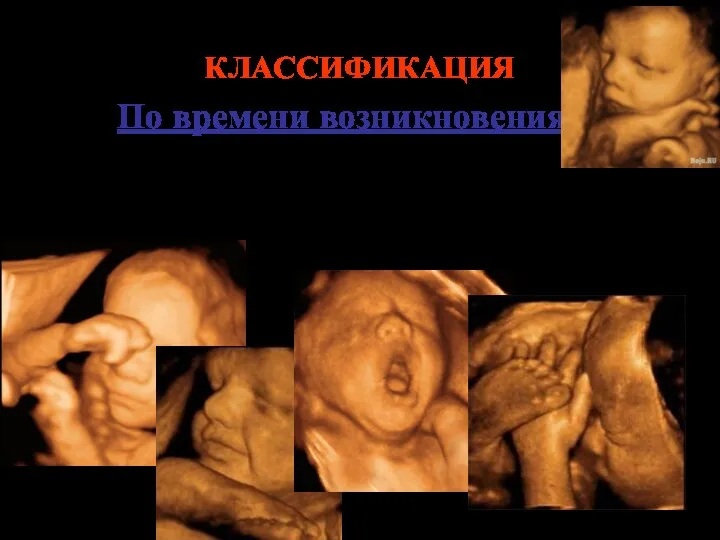 КЛАССИФИКАЦИЯ По времени возникновения: Гипоксия: внутриутробная и постнатальная – гипоксия плода и гипоксия новорожденного.