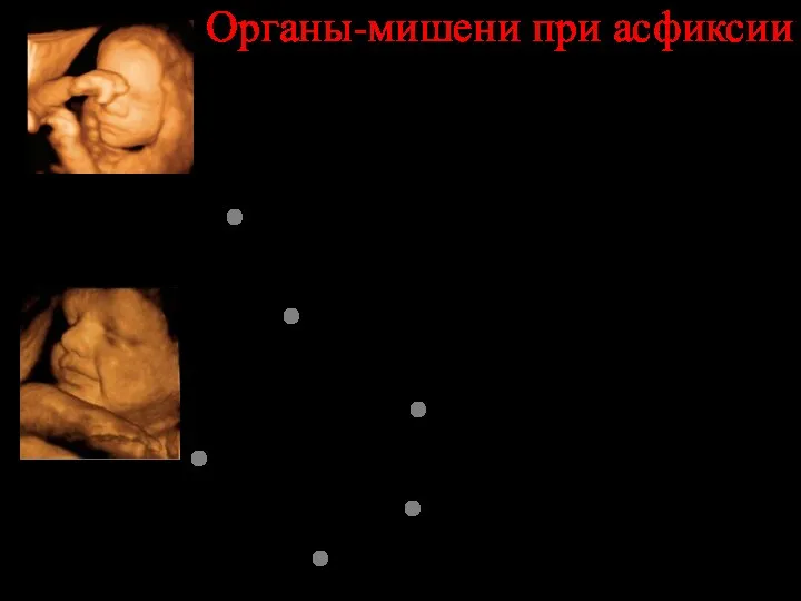 Органы-мишени при асфиксии ЦНС (гипоксическое поражение ЦНС) Сердечно-сосудистая система (ишемия