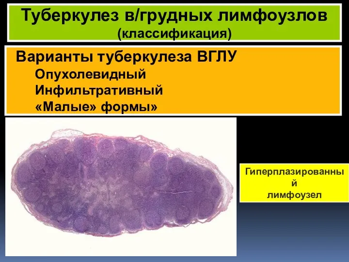 Варианты туберкулеза ВГЛУ Опухолевидный Инфильтративный «Малые» формы» Туберкулез в/грудных лимфоузлов (классификация) Гиперплазированный лимфоузел