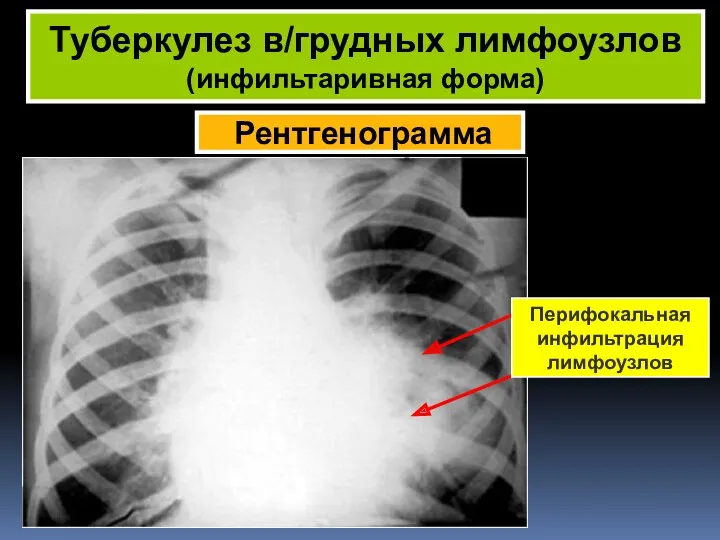Рентгенограмма Туберкулез в/грудных лимфоузлов (инфильтаривная форма) Перифокальная инфильтрация лимфоузлов