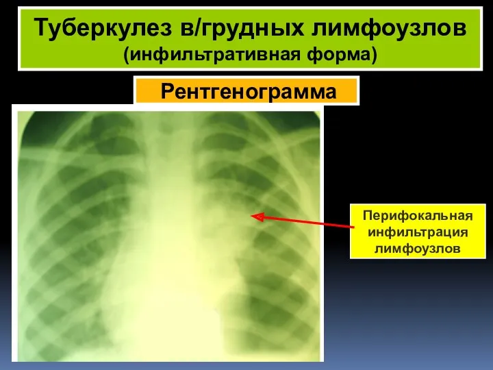 Рентгенограмма Туберкулез в/грудных лимфоузлов (инфильтративная форма) Перифокальная инфильтрация лимфоузлов