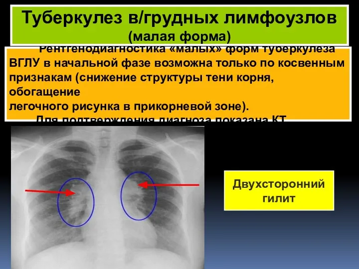 Рентгенодиагностика «малых» форм туберкулеза ВГЛУ в начальной фазе возможна только