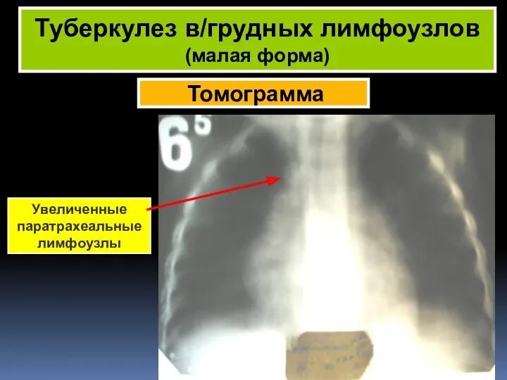 Томограмма Туберкулез в/грудных лимфоузлов (малая форма) Увеличенные паратрахеальные лимфоузлы