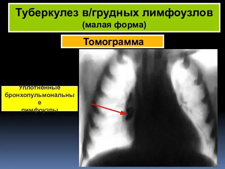 Томограмма Туберкулез в/грудных лимфоузлов (малая форма) Уплотненные бронхопульмональные лимфоузлы