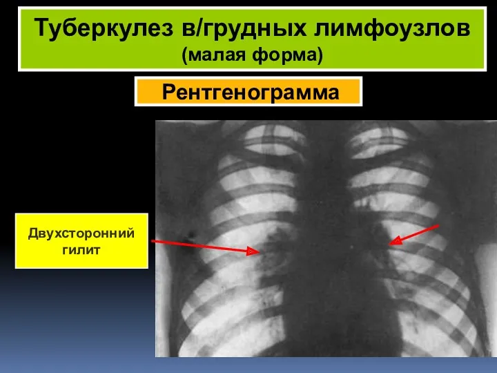 Рентгенограмма Туберкулез в/грудных лимфоузлов (малая форма) Двухсторонний гилит