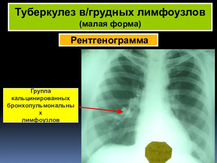Рентгенограмма Туберкулез в/грудных лимфоузлов (малая форма) Группа кальцинированных бронхопульмональных лимфоузлов