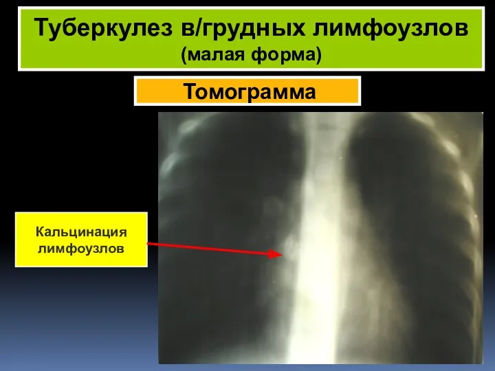 Томограмма Туберкулез в/грудных лимфоузлов (малая форма) Кальцинация лимфоузлов
