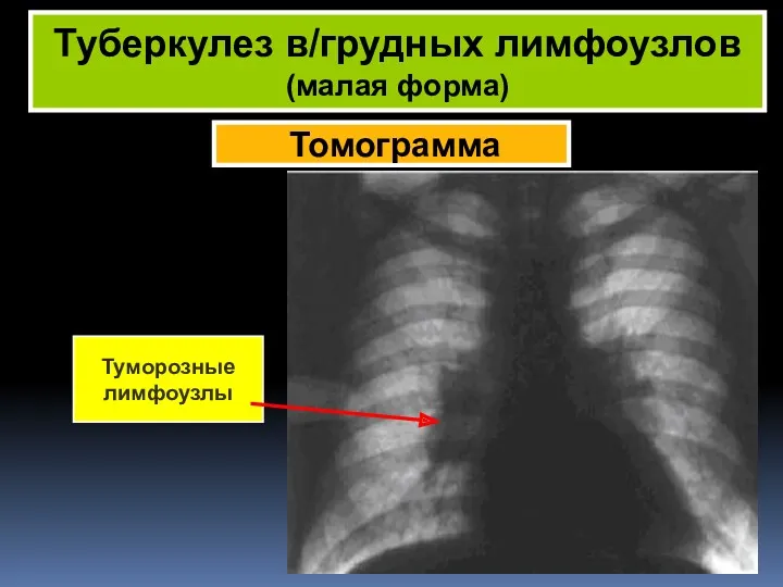 Томограмма Туберкулез в/грудных лимфоузлов (малая форма) Туморозные лимфоузлы