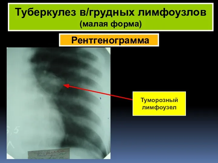 Рентгенограмма Туберкулез в/грудных лимфоузлов (малая форма) Туморозный лимфоузел
