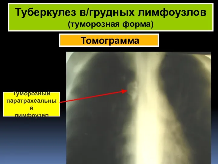 Томограмма Туберкулез в/грудных лимфоузлов (туморозная форма) Туморозный паратрахеальный лимфоузел