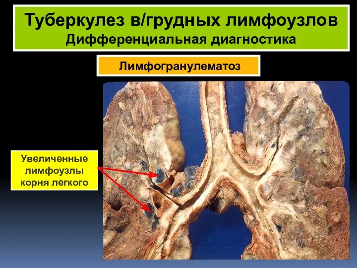 Лимфогранулематоз Туберкулез в/грудных лимфоузлов Дифференциальная диагностика Увеличенные лимфоузлы корня легкого