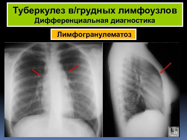 Лимфогранулематоз Туберкулез в/грудных лимфоузлов Дифференциальная диагностика