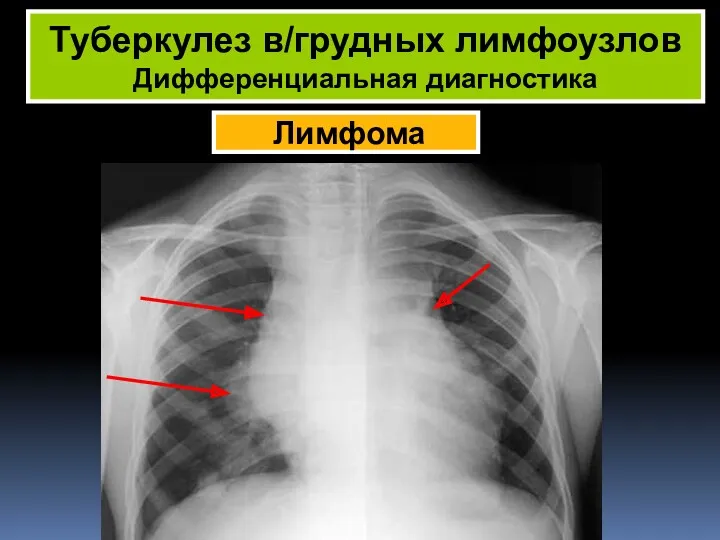 Лимфома Туберкулез в/грудных лимфоузлов Дифференциальная диагностика