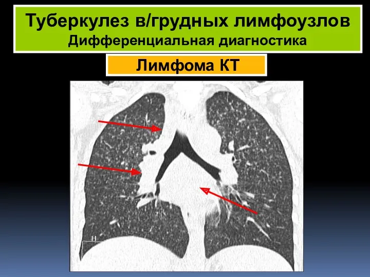 Лимфома КТ Туберкулез в/грудных лимфоузлов Дифференциальная диагностика