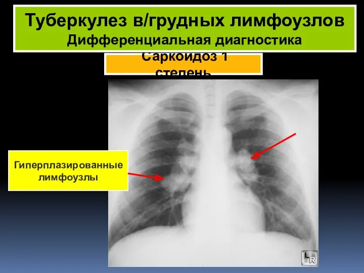 Саркоидоз 1 степень Туберкулез в/грудных лимфоузлов Дифференциальная диагностика Гиперплазированные лимфоузлы