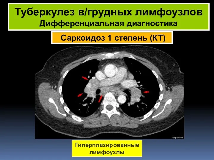 Саркоидоз 1 степень (КТ) Туберкулез в/грудных лимфоузлов Дифференциальная диагностика Гиперплазированные лимфоузлы