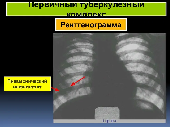 Рентгенограмма Первичный туберкулезный комплекс Пневмонический инфильтрат