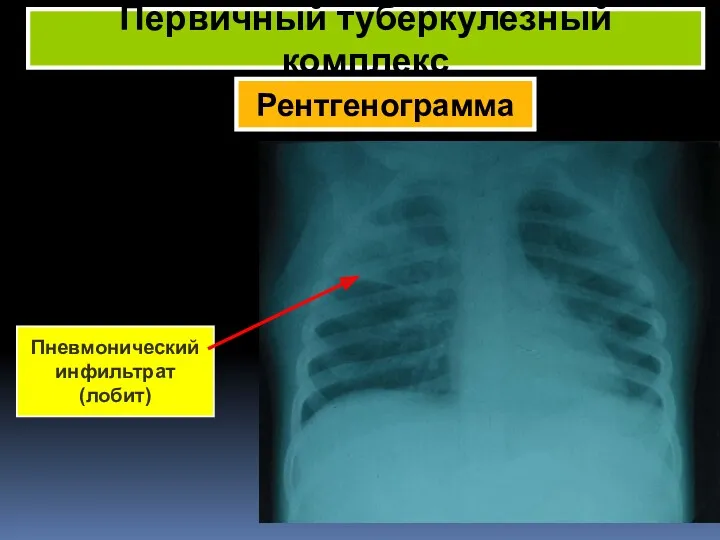 Рентгенограмма Первичный туберкулезный комплекс Пневмонический инфильтрат (лобит)