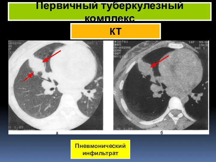 КТ Первичный туберкулезный комплекс Пневмонический инфильтрат
