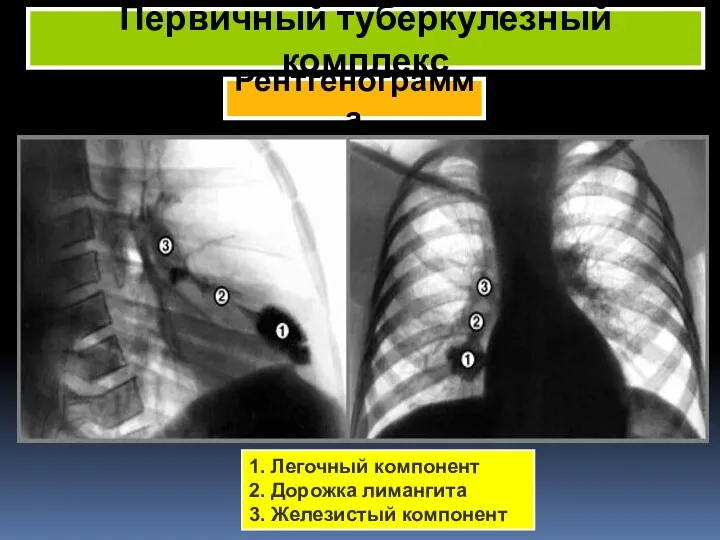 Рентгенограмма Первичный туберкулезный комплекс 1. Легочный компонент 2. Дорожка лимангита 3. Железистый компонент