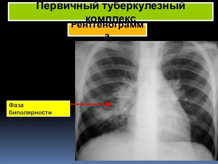 Рентгенограмма Первичный туберкулезный комплекс Фаза биполярности